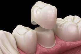 Loose Crown Problem Chat, Discussing Loose Crowns Blog online.  Loose Crowns Problems Discussion and Dental Crown Problem Chat